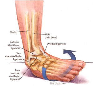 ankle sprain